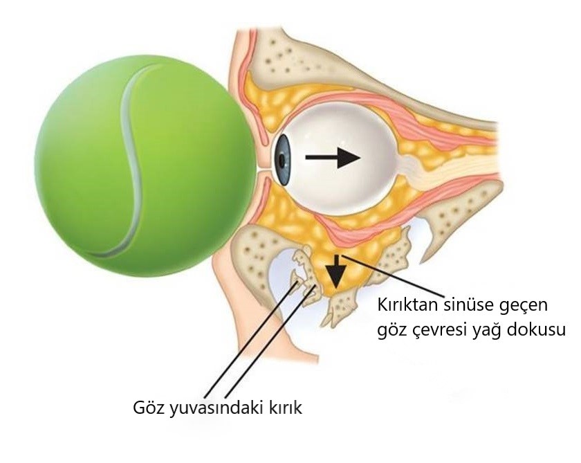 TENİS OYUNLARINDA POTANSİYEL TEHLİKE: BLOW OUT KIRIKLARI!